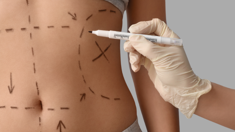 Cada técnica – Liposucción, Lipo HD o Lipo LAD – tiene indicaciones específicas, afirma Dr. Gilberson Wanderley Silva.